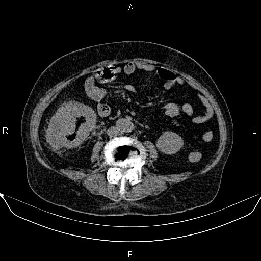 File:Colon cancer (Radiopaedia 90215-107432 Axial non-contrast 53).jpg