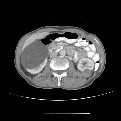 Colon cancer with calcified liver metastasis (Radiopaedia 74423-85307 A 32).jpg