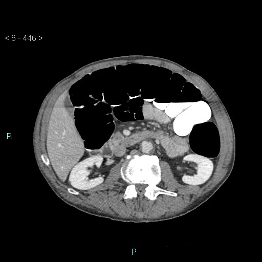 File:Colonic cancer (ultrasound and TC imaging) (Radiopaedia 50346-55713 A 43).jpg