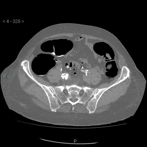 Colonic lipomas (Radiopaedia 49137-54244 Axial bone window 146).jpg