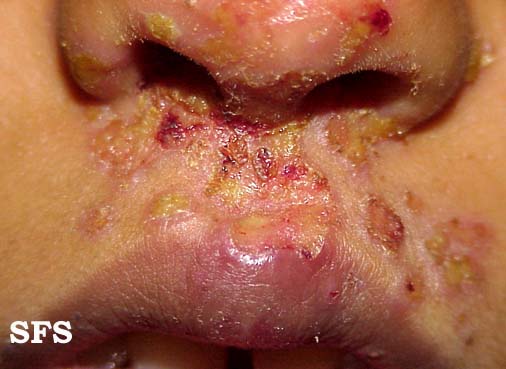 File:Impetigo (Dermatology Atlas 2).jpg
