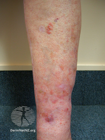 Intraepidermal carcinoma (DermNet NZ lesions-scc-in-situ-2980).jpg