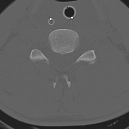 File:Multitrauma with diffuse axonal injury, temporal bone fractures and traumatic caroticocavernous fistula (Radiopaedia 37242-39035 Axial 172).png