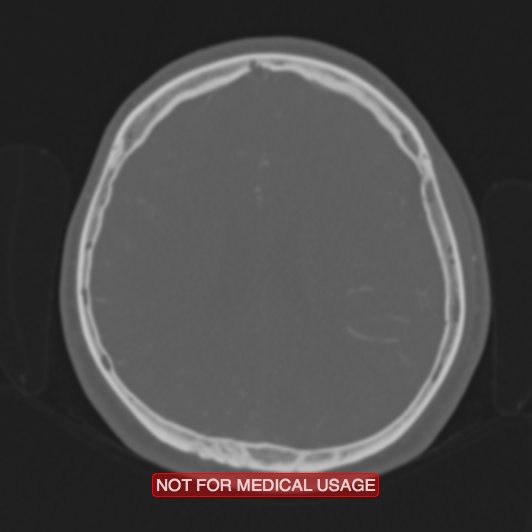Nasopharyngeal carcinoma recurrence - skull base destruction (Radiopaedia 29107-29490 Axial bone window 37).jpg