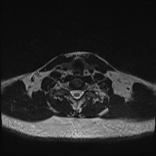 Nasopharyngeal carcinoma with perineural spread (Radiopaedia 55030-61380 Axial T2 74).jpg