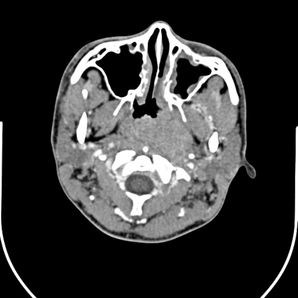 Nasopharyngeal carcinoma with skull base invasion (Radiopaedia 53415-59705 A 53).jpg