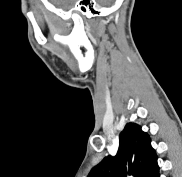 Nasopharyngeal carcinoma with skull base invasion (Radiopaedia 53415-59705 C 14).jpg