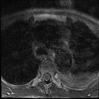 File:Nasopharyngeal carcinoma with skull base invasion (Radiopaedia 59258-66600 Axial T1 38).jpg