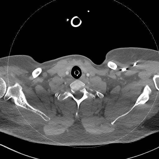 Neck CT angiogram (intraosseous vascular access) (Radiopaedia 55481-61945 B 120).jpg