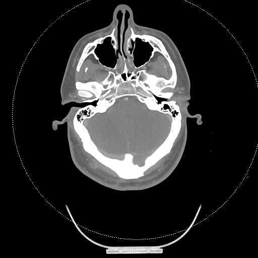 Neck CT angiogram (intraosseous vascular access) (Radiopaedia 55481-61945 B 270).jpg