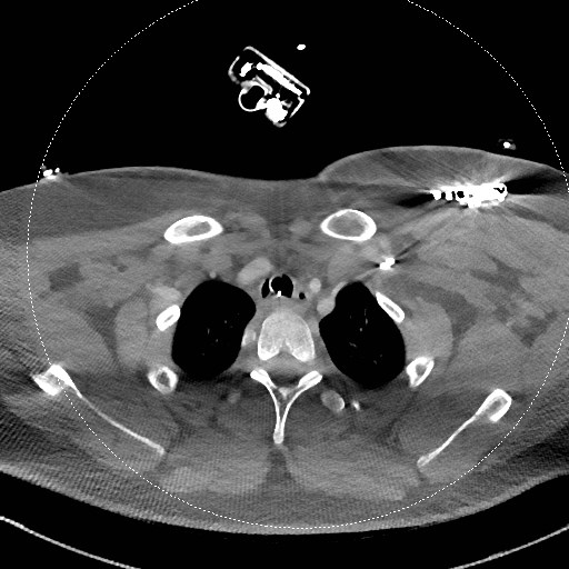Neck CT angiogram (intraosseous vascular access) (Radiopaedia 55481-61945 B 90).jpg