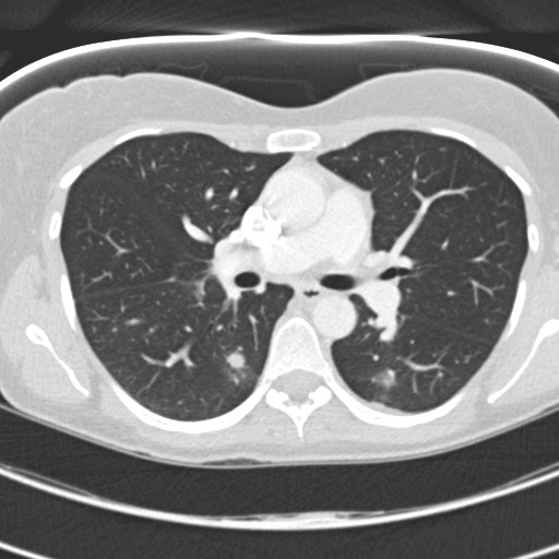 Necrobiotic pulmonary nodules - Crohn disease (Radiopaedia 20723-20631 Axial lung window 61).jpg