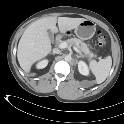 File:Necrotizing pancreatitis with acute necrotic collections (Radiopaedia 38829-41012 B 28).png