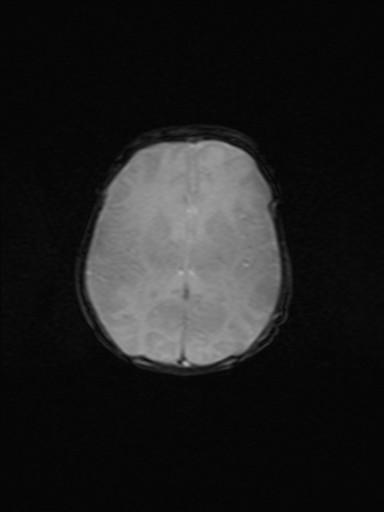 File:Neonatal hypoxic-ischemic encephalopathy (Radiopaedia 41406-44277 Axial Gradient Echo 9).jpg