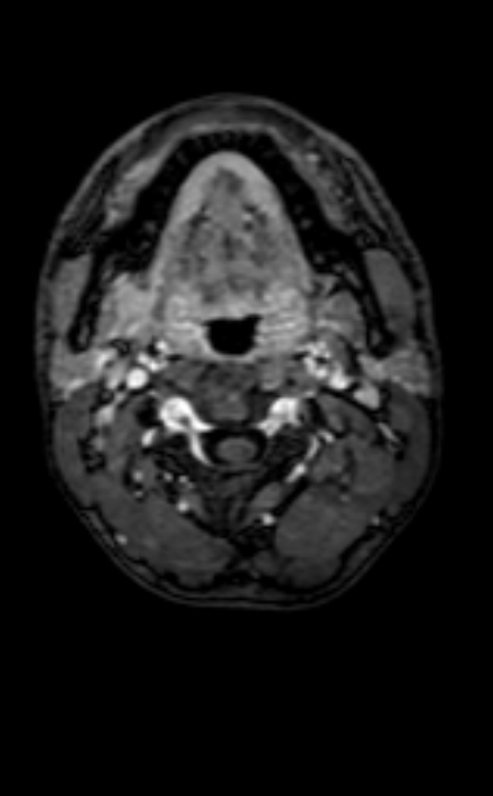 Neuro-Behçet disease (Radiopaedia 90112-107294 Axial T1 C+ 237).jpg