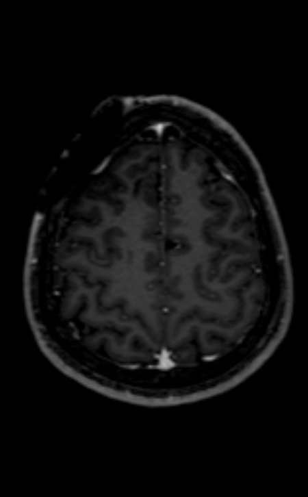 Neuro-Behçet disease (Radiopaedia 90112-107294 Axial T1 C+ 77).jpg