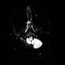 File:Neuro-Behcet's disease (Radiopaedia 21557-21506 Axial DWI 4).jpg