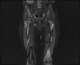 File:Neuroblastoma with bone metastases (Radiopaedia 67080-76414 Coronal STIR 13).jpg
