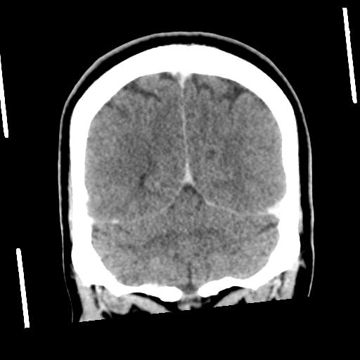 Neurocysticercosis - granular nodular (Radiopaedia 42786-45957 Coronal C+ 50).png