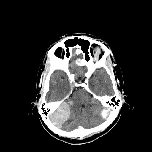 File:Neurofibromatosis type 2 (Radiopaedia 25389-25637 Axial C+ 22).jpg