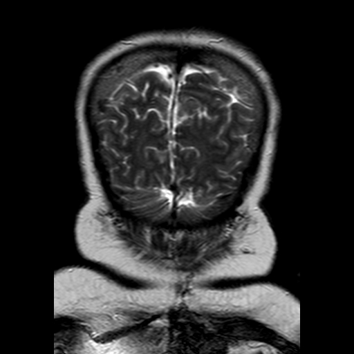 File:Neurofibromatosis type 2 (Radiopaedia 8713-9518 Coronal T2 23).jpg