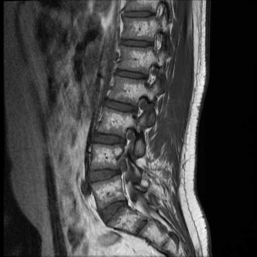 File:Neurofibromatosis type 2 (spinal manifestations) (Radiopaedia 53943-60070 F 10).png