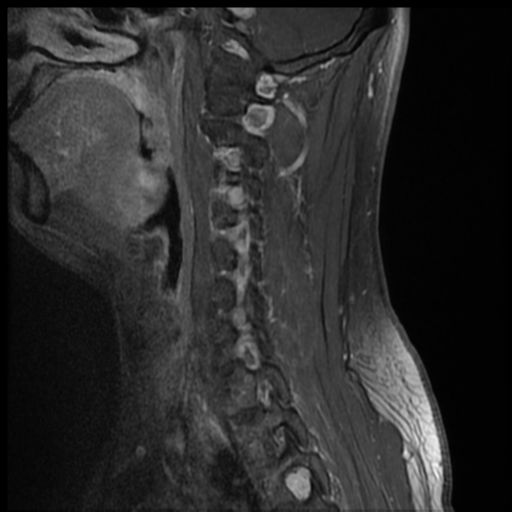 File:Neurofibromatosis type 2 (spinal manifestations) (Radiopaedia 53943-60070 G 10).png