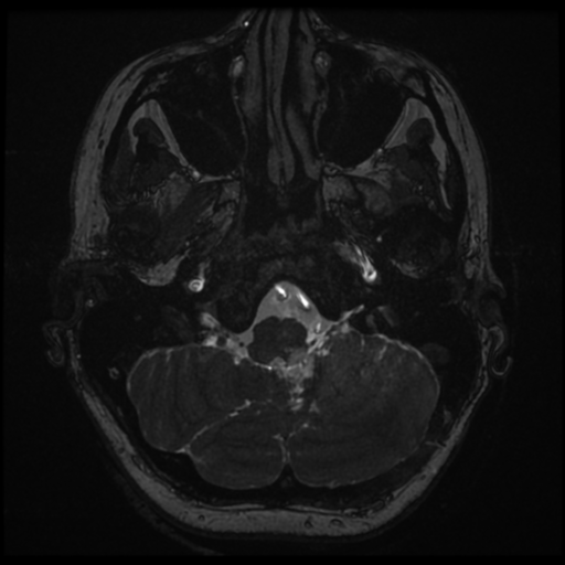 Neurofibromatosis type 2 - bilateral acoustic neuromata (Radiopaedia 40060-42566 Axial FIESTA 14).png