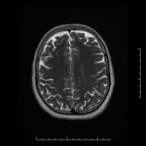File:Neuroglial cyst of brainstem (Radiopaedia 29134-29526 Axial T2 16).jpg