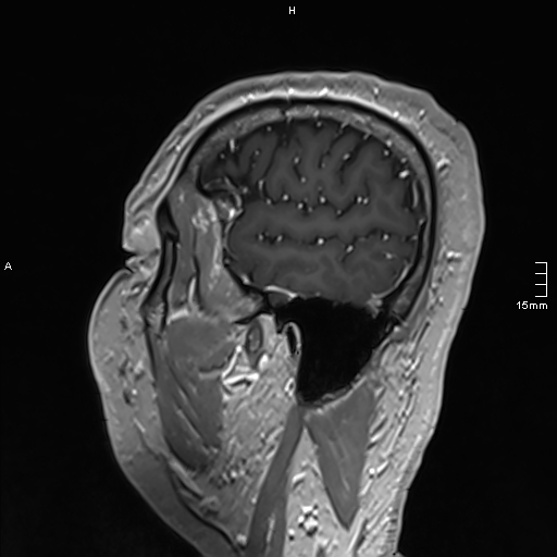 Neurosarcoidosis - involvement of the mesial temporal lobes (Radiopaedia 67429-76820 Sagittal T1 C+ 29).jpg