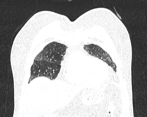 Non-specific interstitial pneumonia (NSIP) (Radiopaedia 68599-78228 Coronal lung window 14).jpg