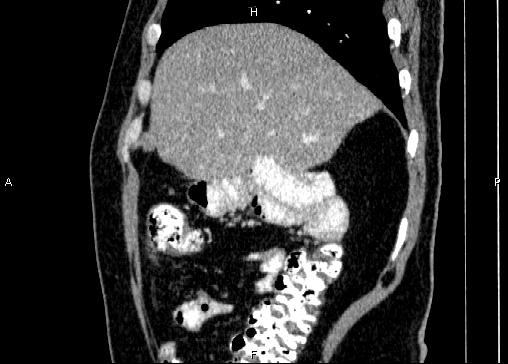Non-syndromic pancreatic endocrine tumor (Radiopaedia 86958-103178 E 21).jpg