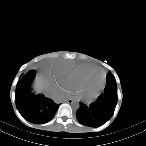 File:Non hodgkin lymphoma of the mediastinum (Radiopaedia 20814-20729 Axial non-contrast 27).jpg