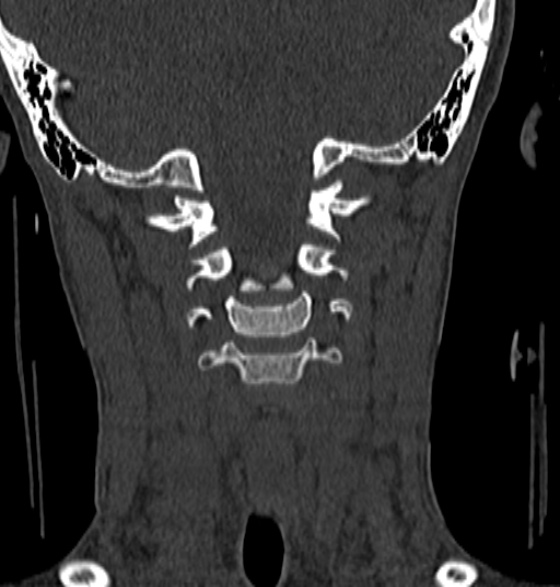 File:Normal CT cervical spine - 12-year-old (Radiopaedia 55352-61775 Coronal bone window 87).jpg