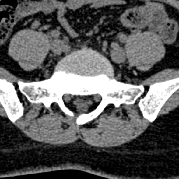 Normal CT lumbar spine (Radiopaedia 53981-60118 Axial non-contrast 88).jpg