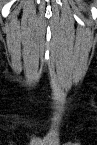 Normal CT lumbar spine (Radiopaedia 53981-60118 F 98).jpg