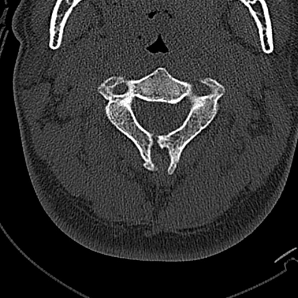 Normal CT of the cervical spine (Radiopaedia 53322-59305 Axial bone window 89).jpg