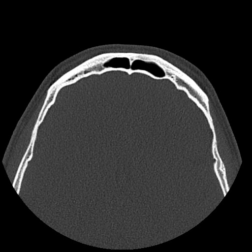 Normal CT paranasal sinuses (Radiopaedia 42286-45390 Axial bone window 19).jpg