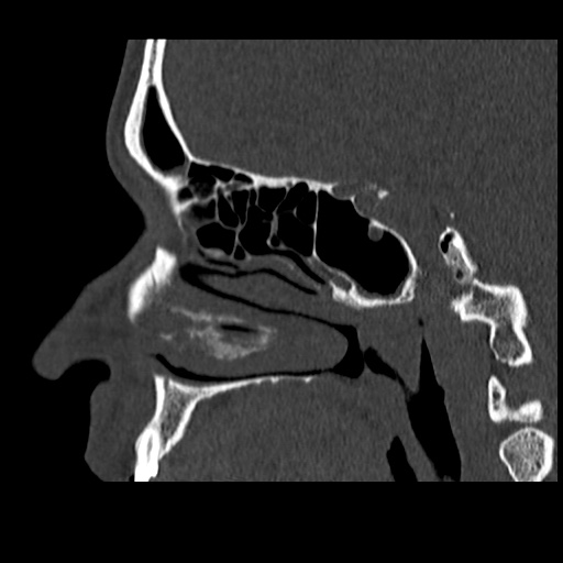 Normal CT paranasal sinuses (Radiopaedia 42286-45390 Sagittal bone window 62).jpg