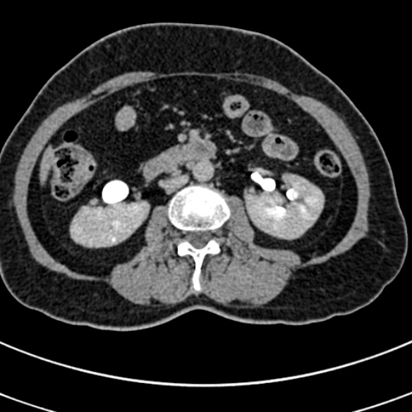 File:Normal CT split bolus study of the renal tract (Radiopaedia 48631-53634 Axial split bolus 103).jpg