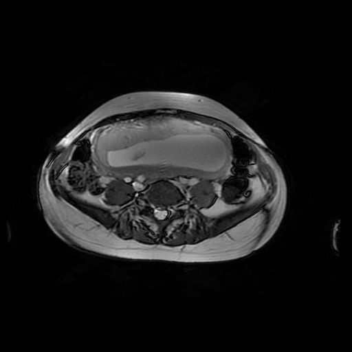 File:Normal MRI abdomen in pregnancy (Radiopaedia 88001-104541 Axial Gradient Echo 35).jpg