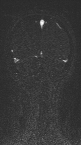 Normal MRI brain with MRV- teenager (Radiopaedia 49425-54553 Coronal MRV 200).jpg