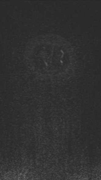Normal MRI brain with MRV- teenager (Radiopaedia 49425-54553 Coronal MRV 224).jpg