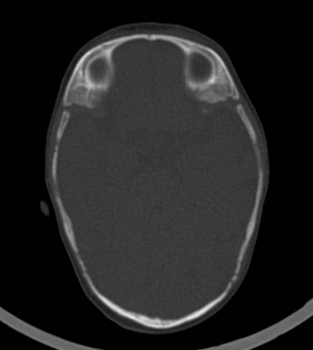 Normal brain CT - 2-month-old (Radiopaedia 53369-59350 Axial bone window 40).jpg