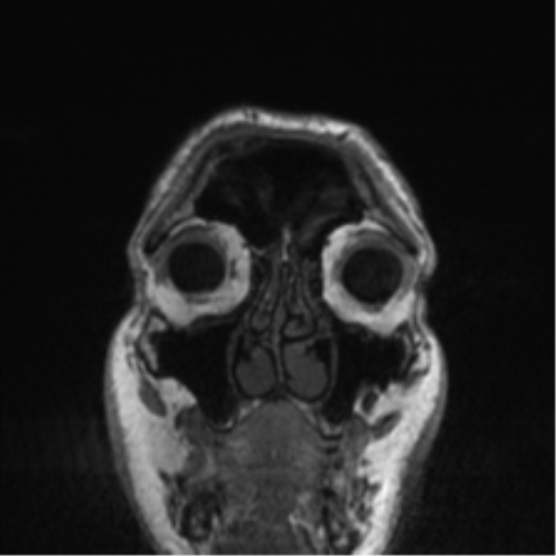 Normal brain MRI (non-focal epilepsy protocol) (Radiopaedia 53917-60040 Coronal T1 60).png