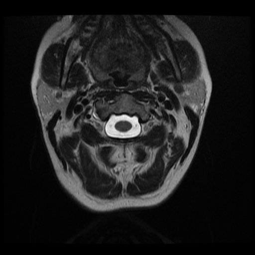 File:Normal cervical and thoracic spine MRI (Radiopaedia 35630-37156 Axial T2 28).png