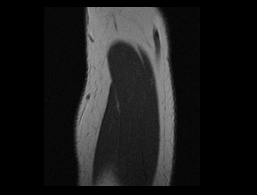 File:Normal elbow arthrograms (Radiopaedia 75550-86805 Sagittal PD 4).jpg