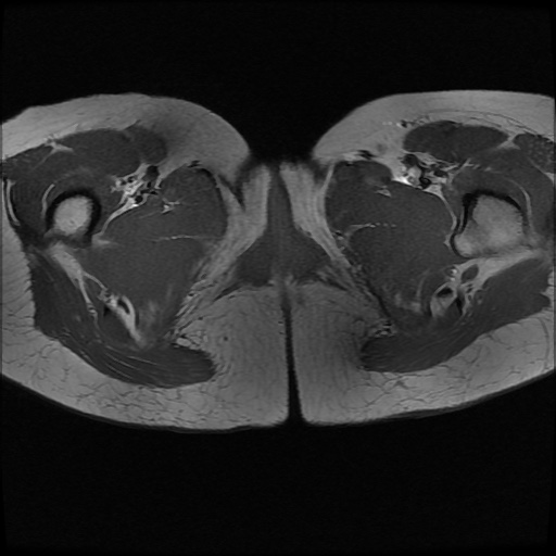File:Normal female pelvis MRI (retroverted uterus) (Radiopaedia 61832-69933 Axial T1 31).jpg