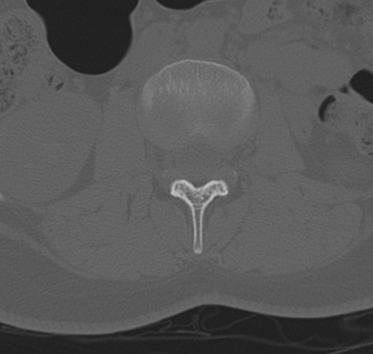 File:Normal lumbosacral CT (Radiopaedia 37923-39867 Axial bone window 46).png