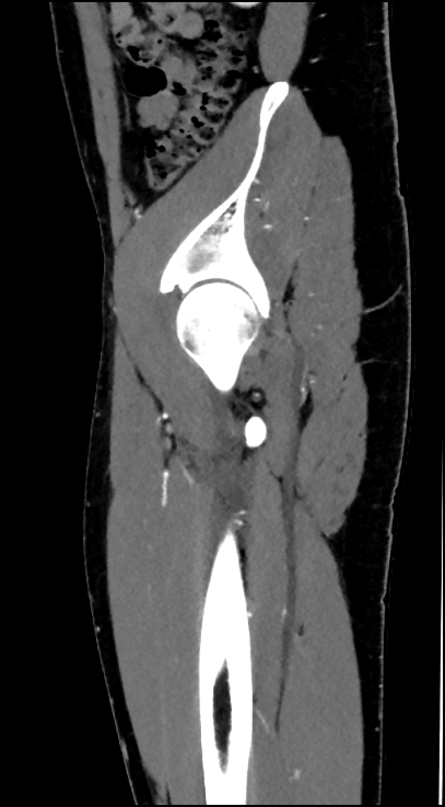 Normal pelvis CT angiogram (Radiopaedia 84966-100481 C 85).jpg